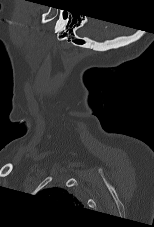Cervical spine ACDF loosening (Radiopaedia 48998-54070 Sagittal bone window 10).png