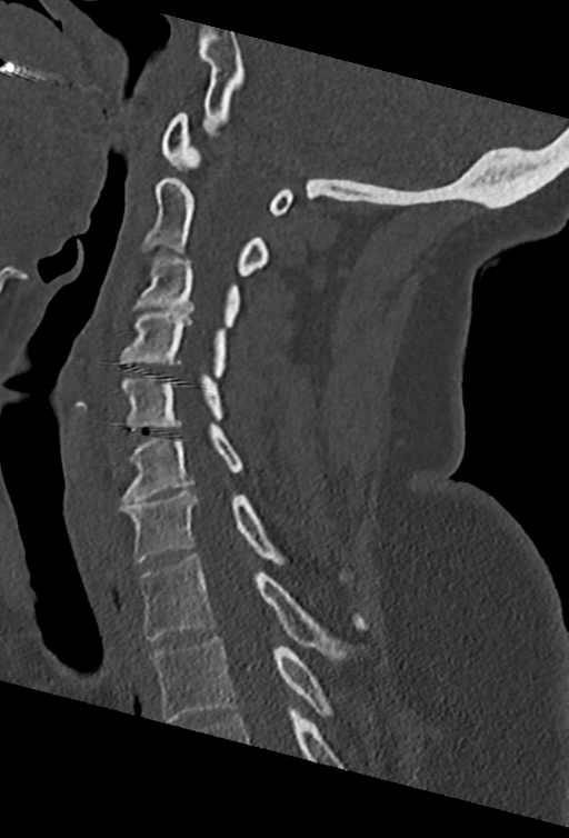 Cervical spine ACDF loosening (Radiopaedia 48998-54070 Sagittal bone window 50).png