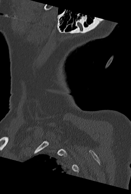 Cervical spine ACDF loosening (Radiopaedia 48998-54070 Sagittal bone window 79).png