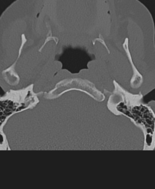 Cervical spine ACDF loosening (Radiopaedia 48998-54071 Axial bone window 6).png