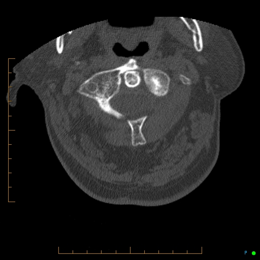 Cervical spine fracture - ankylosing spondylitis (Radiopaedia 76835-88706 Axial bone window 37).jpg