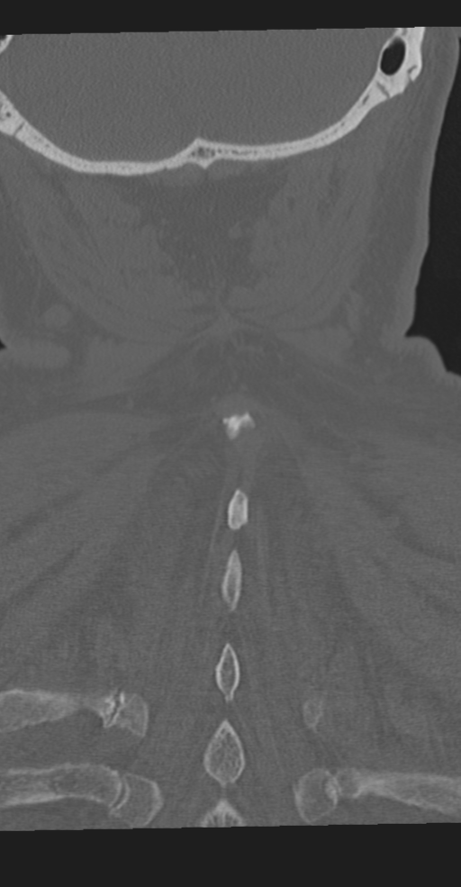 Cervical spine fracture in the setting of ankylosis (Radiopaedia 37038-38715 Coronal bone window 63).png