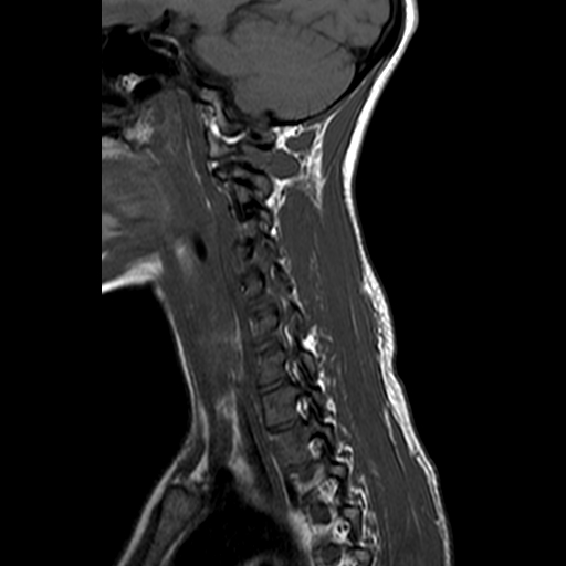 File:Cervical spine posterior ligamentous complex rupture (Radiopaedia 63486-72103 Sagittal T1 3).jpg