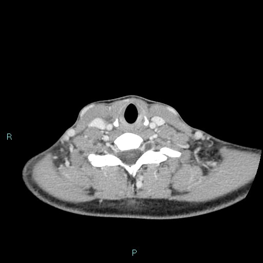 Cervical thymic cyst (Radiopaedia 88632-105335 C 44).jpg