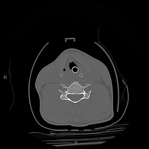 File:Cervical vertebral burst fracture (Radiopaedia 37420-39258 Axial bone window 9).jpg