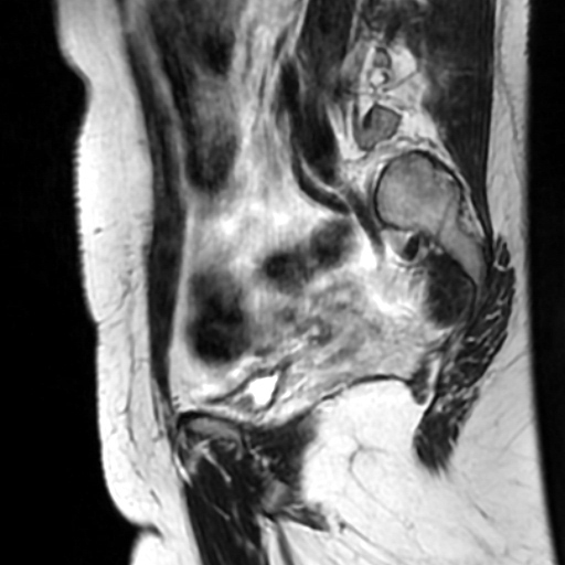 File:Cesarian section scar endometriosis (Radiopaedia 66520-75799 Sagittal T2 7).jpg
