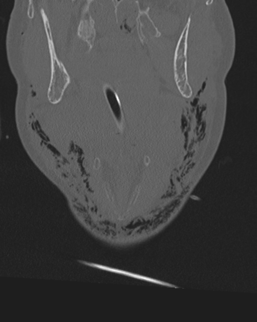 Chalk stick fracture (Radiopaedia 57948-64928 Coronal bone window 9).png