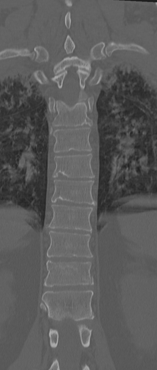 Chance fracture (Radiopaedia 33854-35020 Coronal bone window 53).png