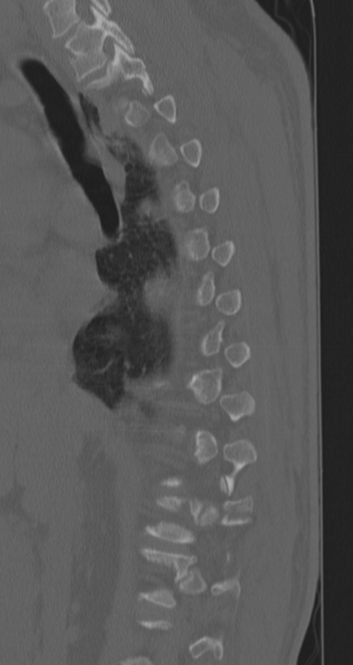 Chance fracture (Radiopaedia 33854-35020 Sagittal bone window 57).png