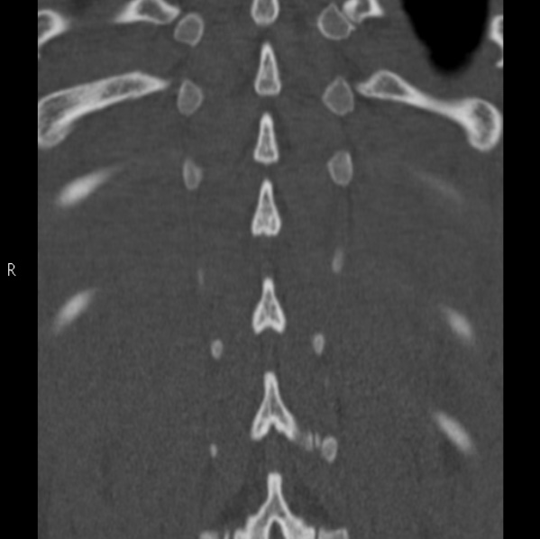 Chance fracture (Radiopaedia 36521-38081 Coronal bone window 55).jpg