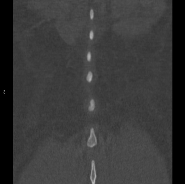 Chance fracture (Radiopaedia 36521-38081 Coronal bone window 68).jpg