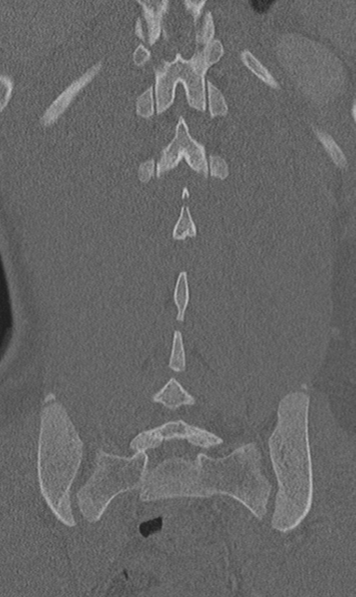 Chance fracture (Radiopaedia 40360-42912 Coronal bone window 54).png