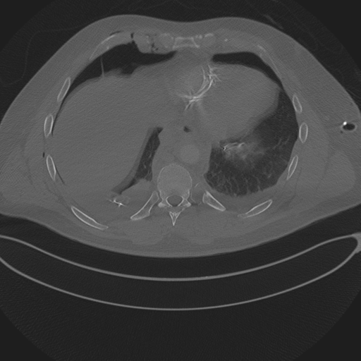 Chest multitrauma - aortic injury (Radiopaedia 34708-36147 Axial bone window 218).png