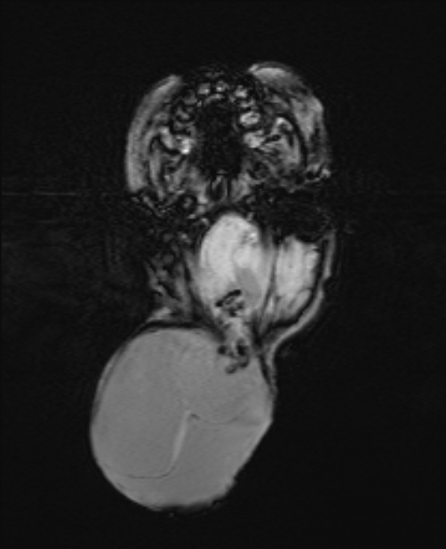 Chiari III malformation with occipital encephalocele (Radiopaedia 79446-92559 Axial SWI 24).jpg