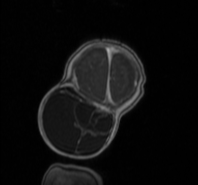 Chiari III malformation with occipital encephalocele (Radiopaedia 79446-92559 Coronal T1 C+ mpr 48).jpg