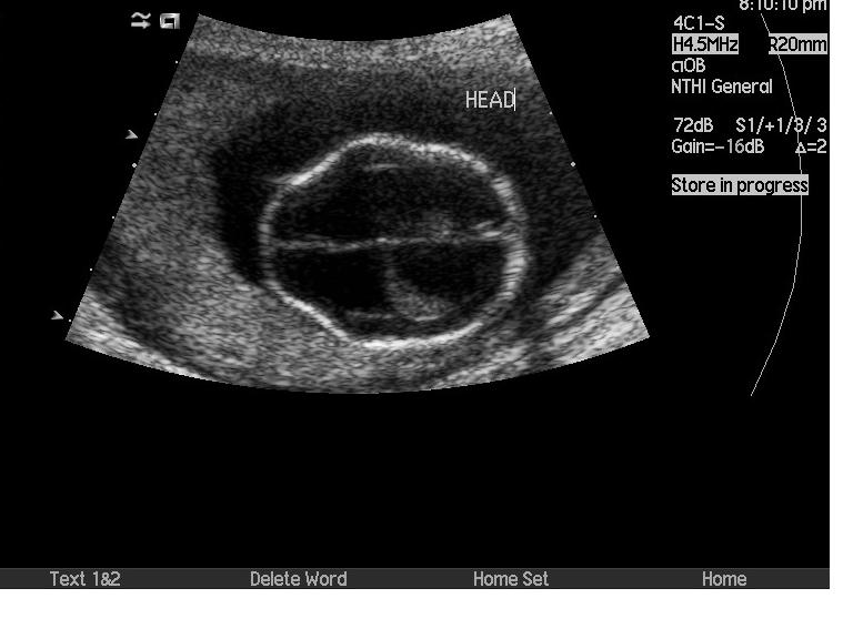 File:Chiari type 2 malformation- antenatal ultrasound (Radiopaedia 16341).jpg