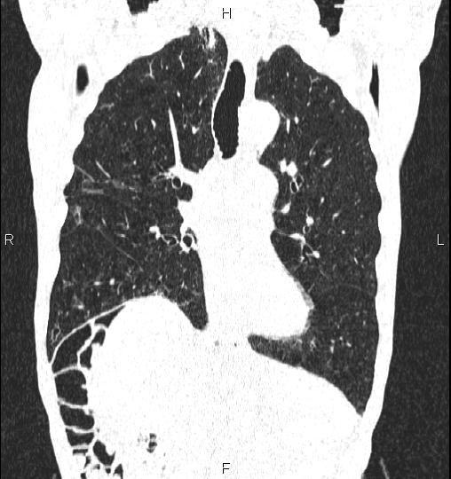 Chilaiditi sign (Radiopaedia 88839-105611 Coronal lung window 29).jpg