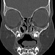 Choanal atresia (Radiopaedia 88525-105975 Coronal bone window 23).jpg