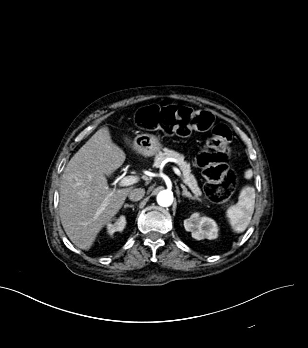 Cholangiocarcinoma with cerebral metastases (Radiopaedia 83519-98629 B 26).jpg