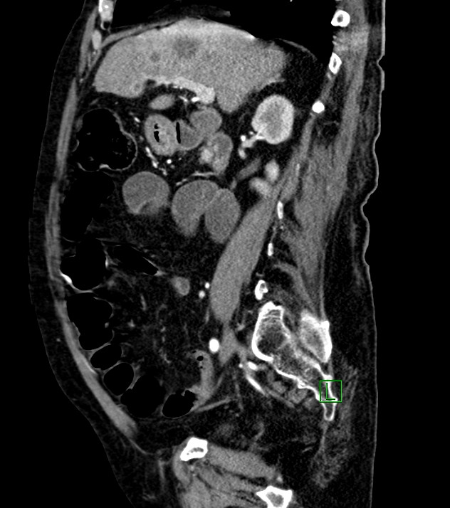 Cholangiocarcinoma with cerebral metastases (Radiopaedia 83519-98629 F 76).jpg