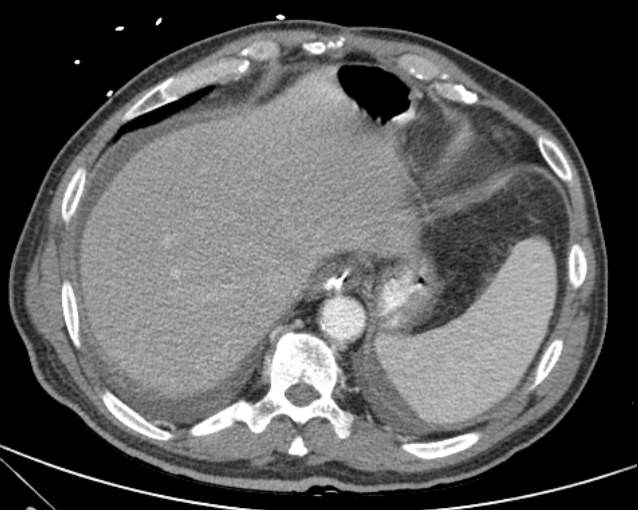 Cholecystitis - perforated gallbladder (Radiopaedia 57038-63916 A 15).jpg