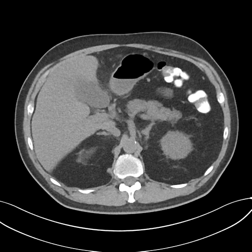 File:Cholecystitis with focal perforation and hepatic abscess (Radiopaedia 37189-38945 Axial non-contrast 25).png