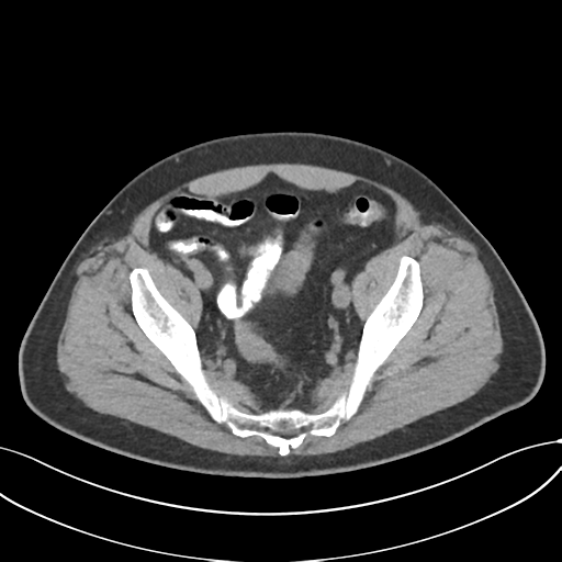 File:Cholecystitis with focal perforation and hepatic abscess (Radiopaedia 37189-38945 Axial non-contrast 72).png