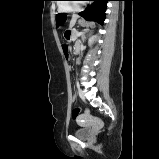 Choledocholithiasis on CT and MRI (Radiopaedia 24825-25087 D 38).jpg