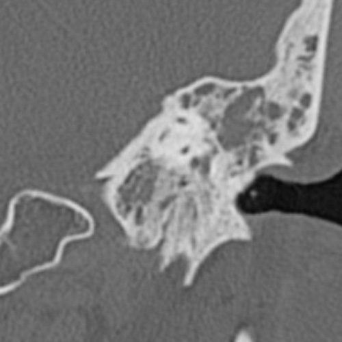 File:Cholesteatoma (Radiopaedia 9408-10093 Coronal bone window 1).jpg