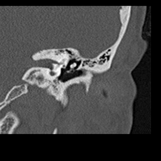 File:Cholesteatoma of the external ear (Radiopaedia 16540-16225 Coronal bone window 10).jpg