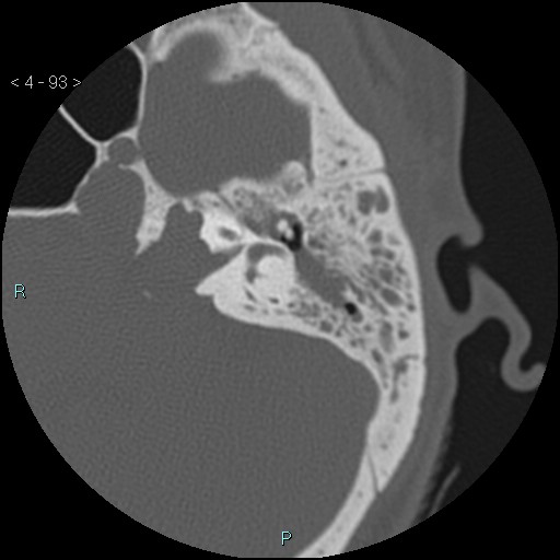 File:Cholesterol granuloma of the petrous apex (Radiopaedia 64358-73141 Axial bone window 45).jpg