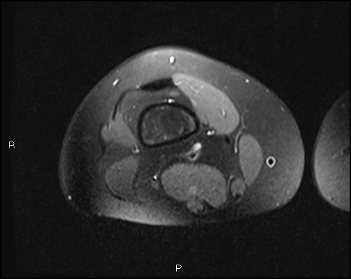 File:Chondroblastoma (Radiopaedia 62721-71031 Axial PD fat sat 4).jpg