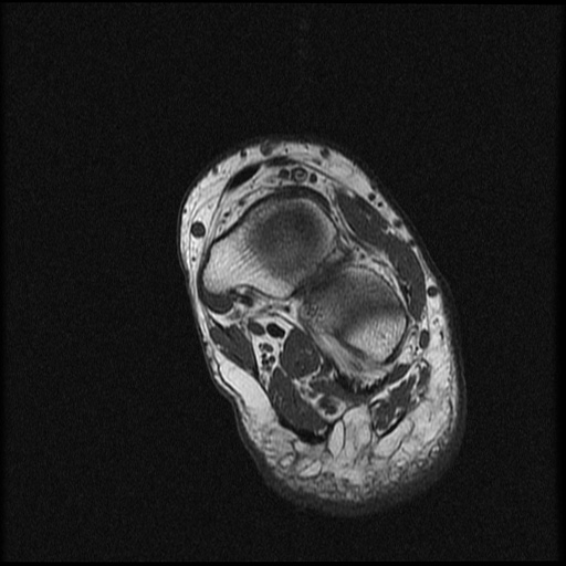 File:Chondroblastoma - midfoot (Radiopaedia 64831-73765 Short axis T1 8).jpg
