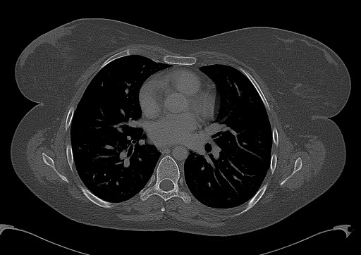 Chondrosarcoma - chest wall (Radiopaedia 65192-74199 Axial bone window 63).jpg