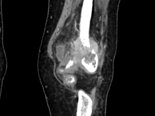 Chondrosarcoma - femur (Radiopaedia 64187-72954 C 17).jpg