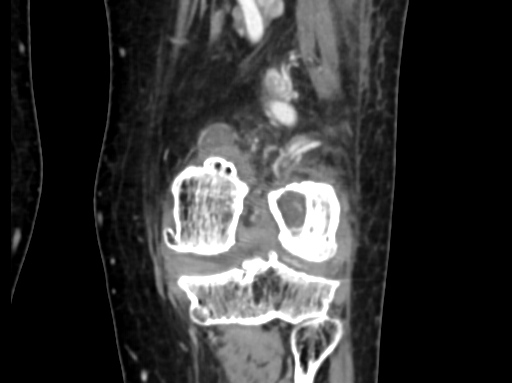 Chondrosarcoma - femur (Radiopaedia 64187-72954 C 39).jpg
