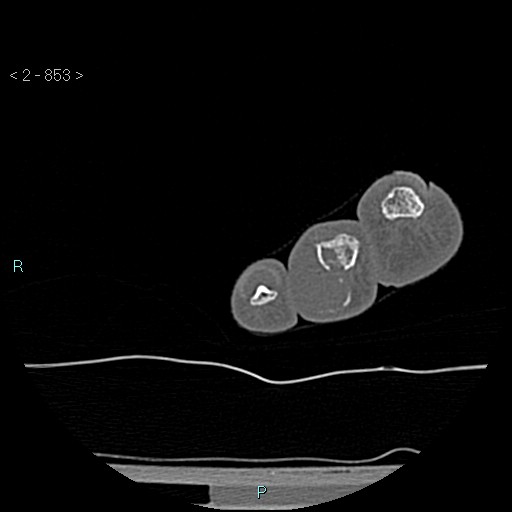 Chondrosarcoma - phalanx (Radiopaedia 69047-78812 Axial bone window 107).jpg