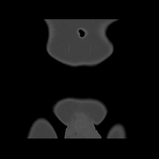 Chondrosarcoma of iliac wing (Radiopaedia 63861-72599 Coronal bone window 14).jpg