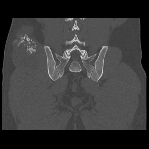 Chondrosarcoma of iliac wing (Radiopaedia 63861-72599 Coronal bone window 86).jpg