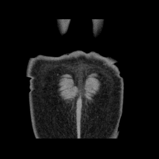 Chondrosarcoma of iliac wing (Radiopaedia 63861-72599 Coronal non-contrast 111).jpg