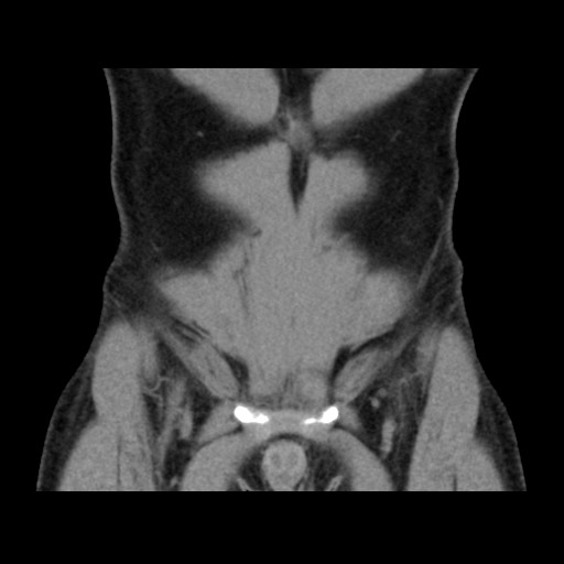 File:Chondrosarcoma of iliac wing (Radiopaedia 63861-72599 Coronal non-contrast 25).jpg