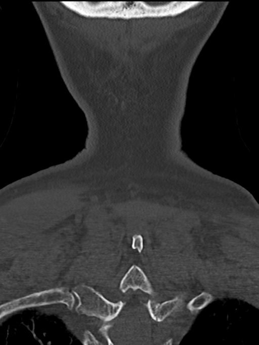 Chordoma (C4 vertebra) (Radiopaedia 47561-52188 Coronal bone window 59).png