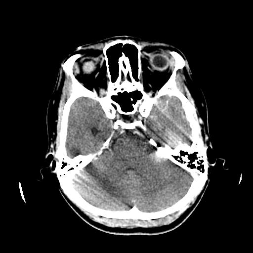 File:Choriocarcinoma of ovary with cerebral and pulmonary metastases (Radiopaedia 25983-26118 C+ arterial phase 44).jpg