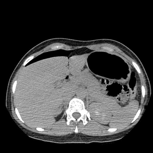 File:Choriocarcinoma of ovary with cerebral and pulmonary metastases (Radiopaedia 25983-26119 Axial non-contrast 82).jpg