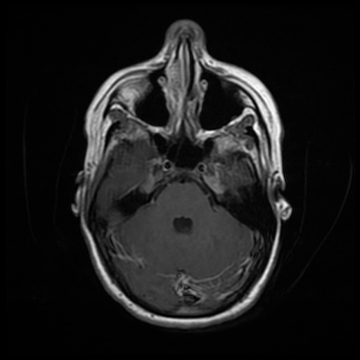File:Choroid plexitis - tuberculous meningitis (Radiopaedia 26344-26484 Axial T1 C+ 2).jpg