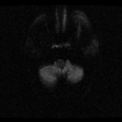 File:Choroid plexus xanthogranuloma (Radiopaedia 17650-17386 DWI 22).jpg