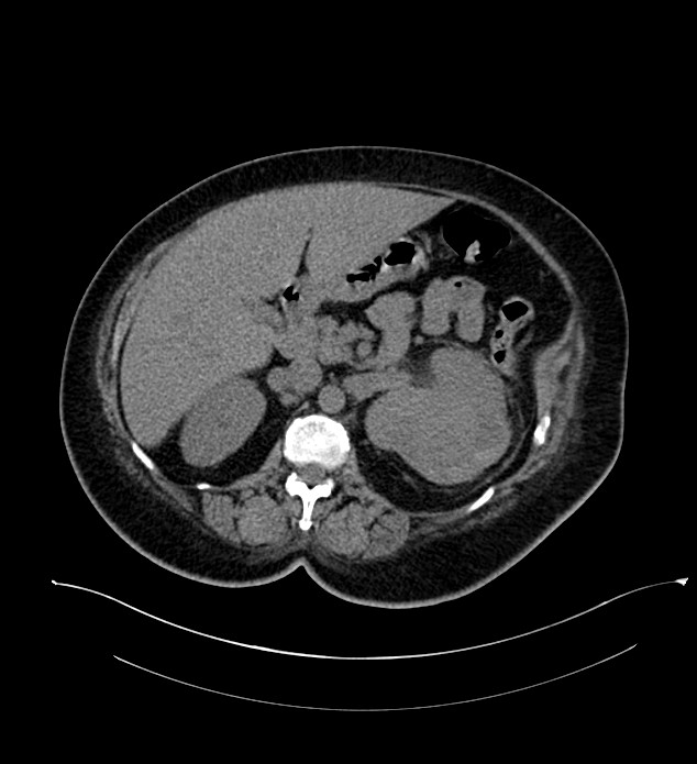 Chromophobe renal cell carcinoma (Radiopaedia 84239-99519 Axial non-contrast 67).jpg