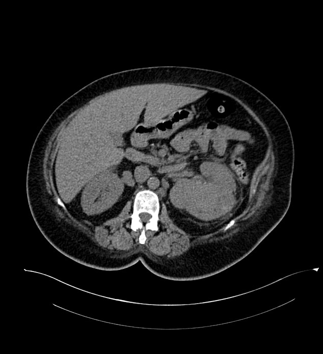 Chromophobe renal cell carcinoma (Radiopaedia 84239-99519 Axial non-contrast 70).jpg