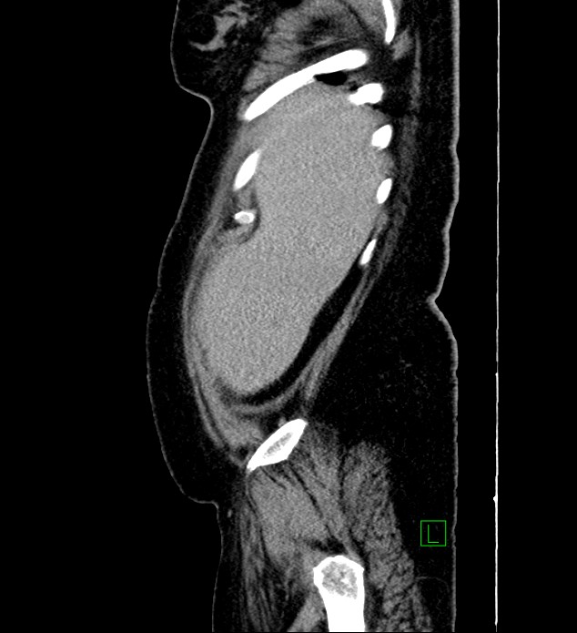 Chromophobe renal cell carcinoma (Radiopaedia 84239-99519 G 103).jpg