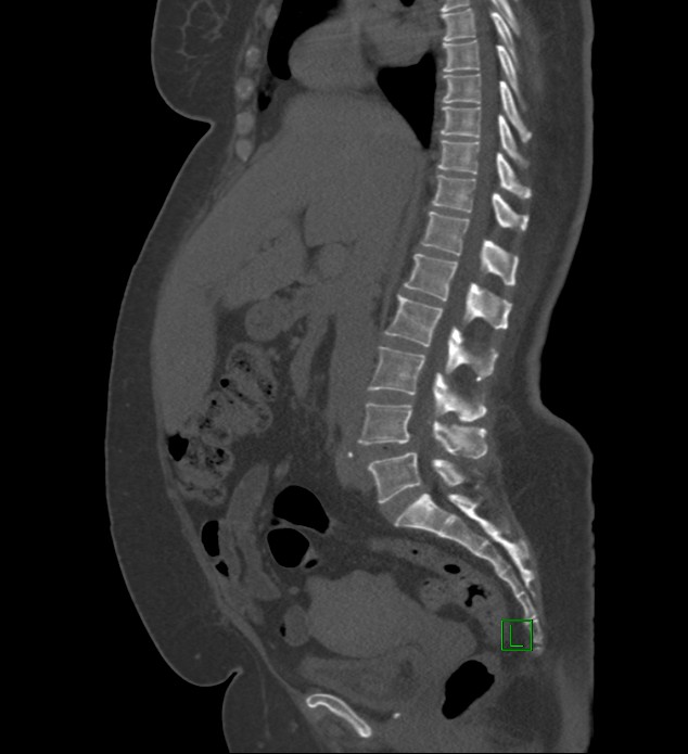 Chromophobe renal cell carcinoma (Radiopaedia 84239-99519 Sagittal bone window 60).jpg